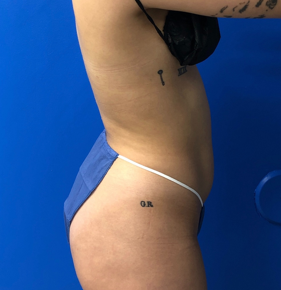 Brazilian Butt Lift Before & After