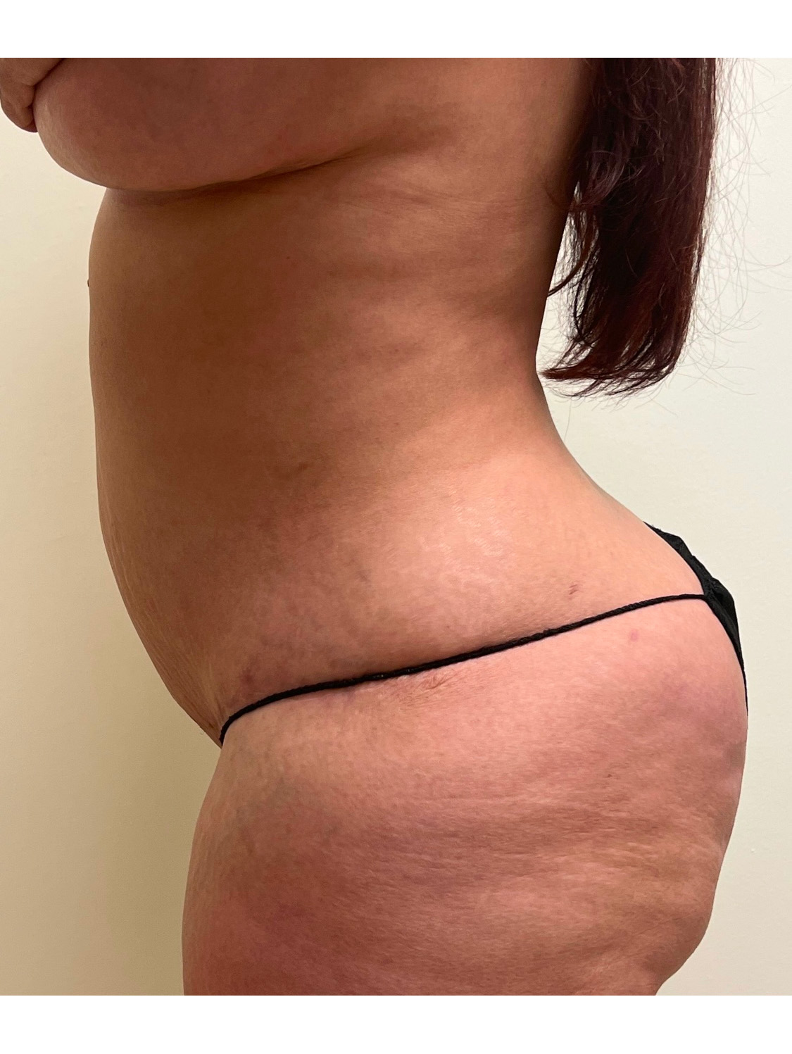 Tummy Tuck