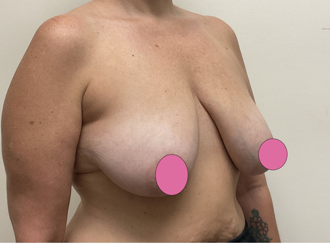 Breast Augmentation with Lift