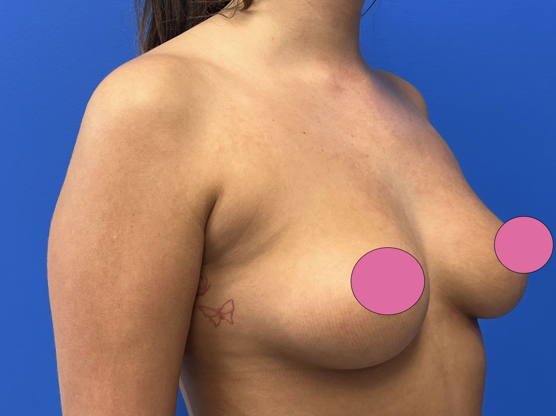 Breast Augmentation Before & After