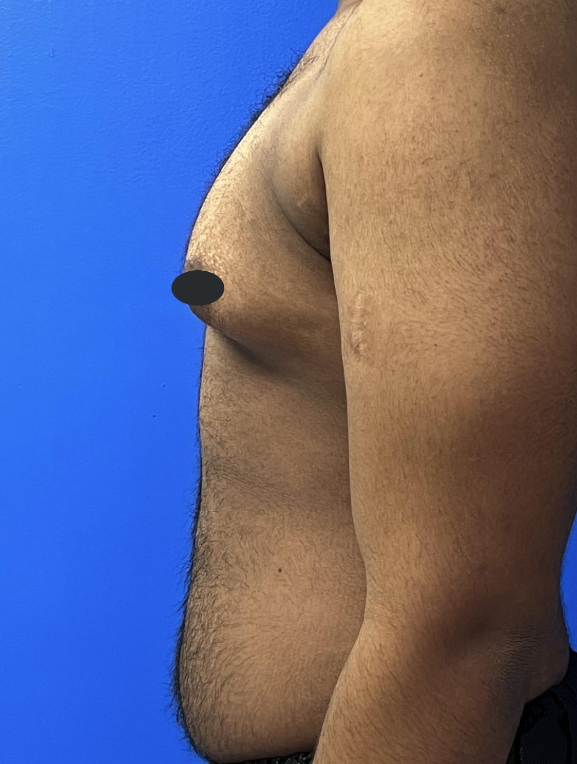 Gynecomastia