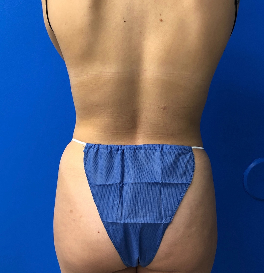 Brazilian Butt Lift Before & After