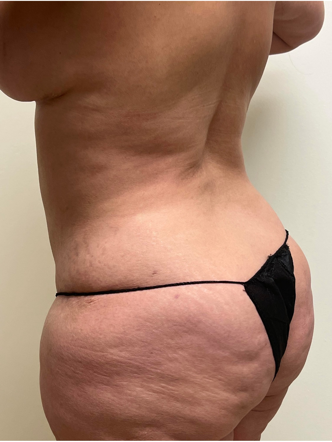 Tummy Tuck