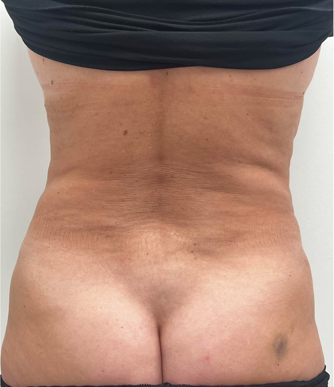 Tummy Tuck