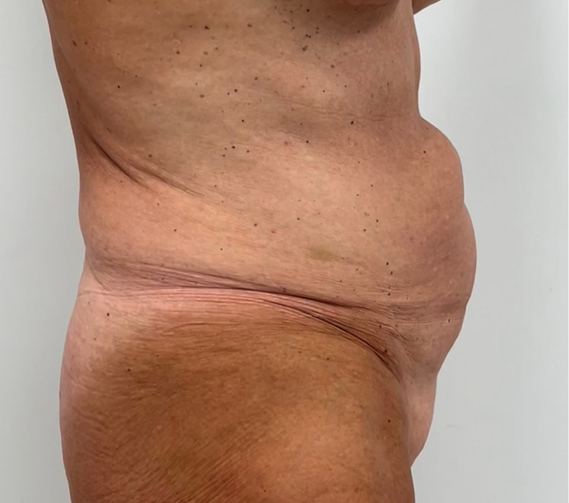 Tummy Tuck