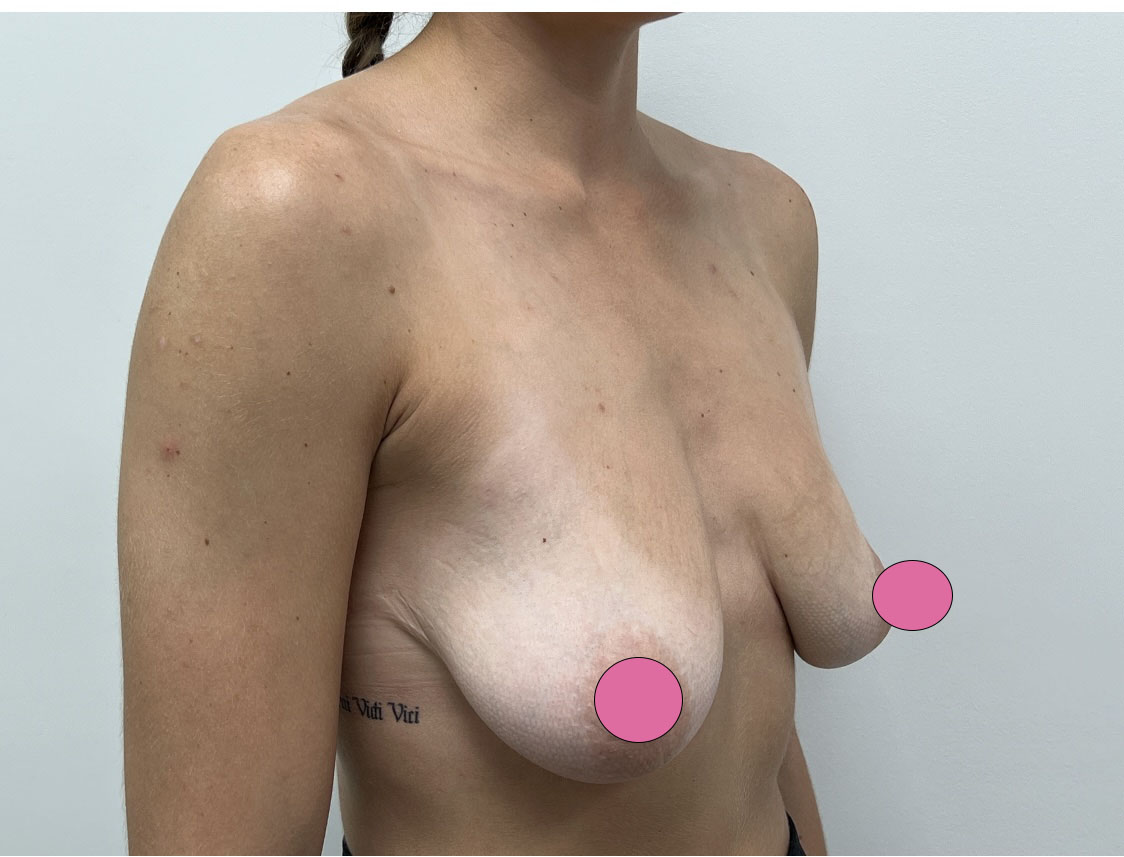 Breast Augmentation with Lift