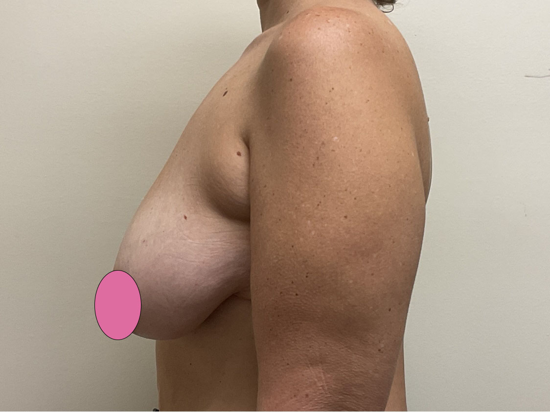 Breast Augmentation with Lift