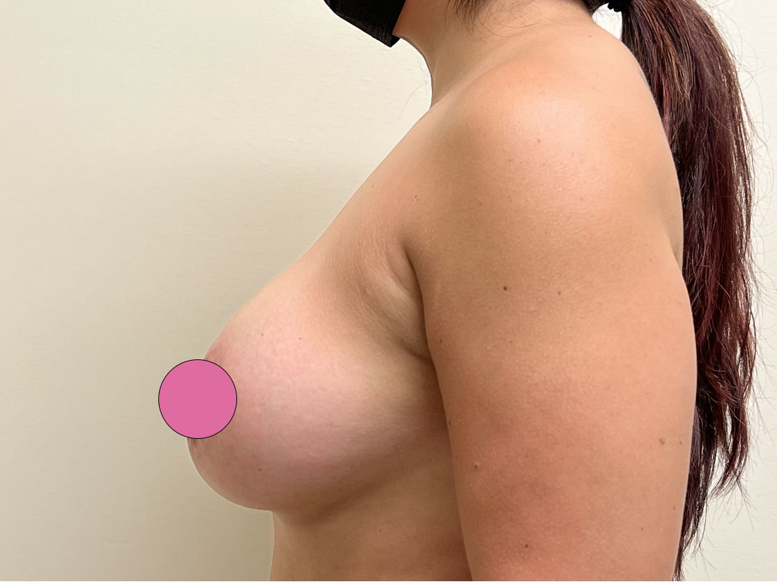 Breast Implant Revision