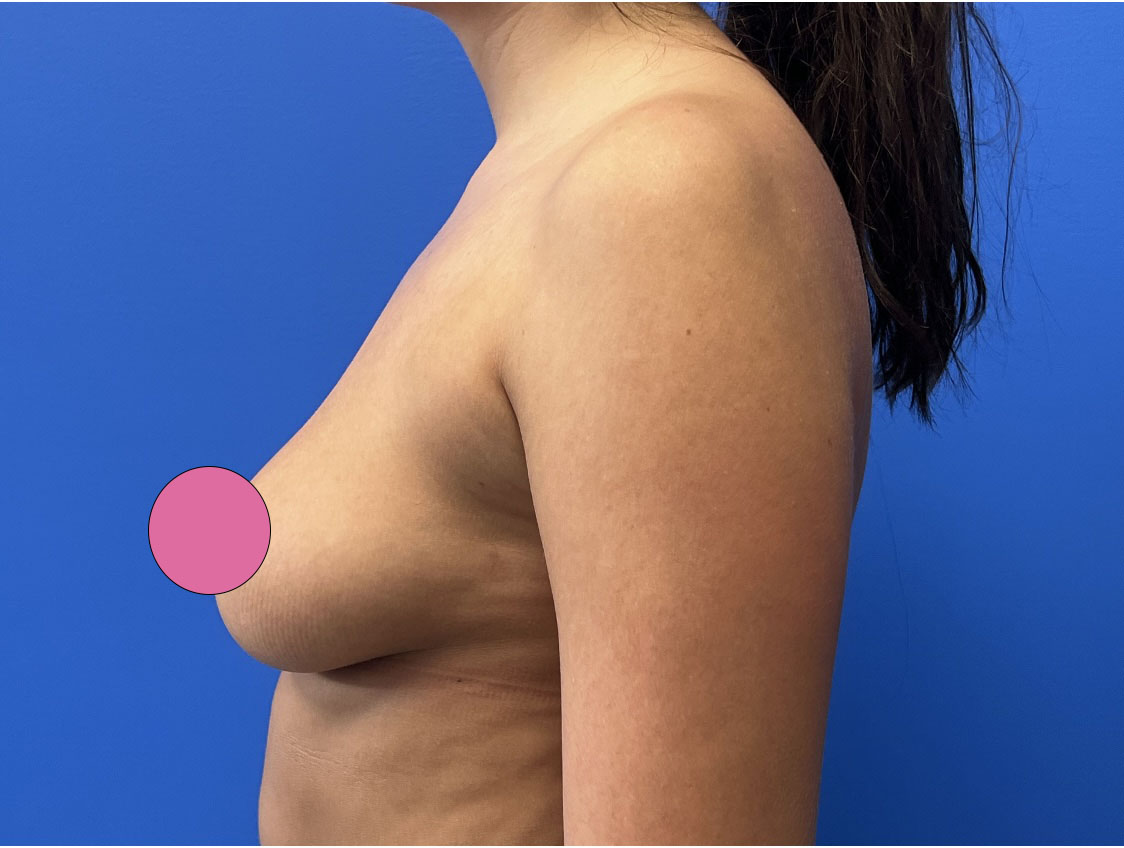 Breast Augmentation Before & After