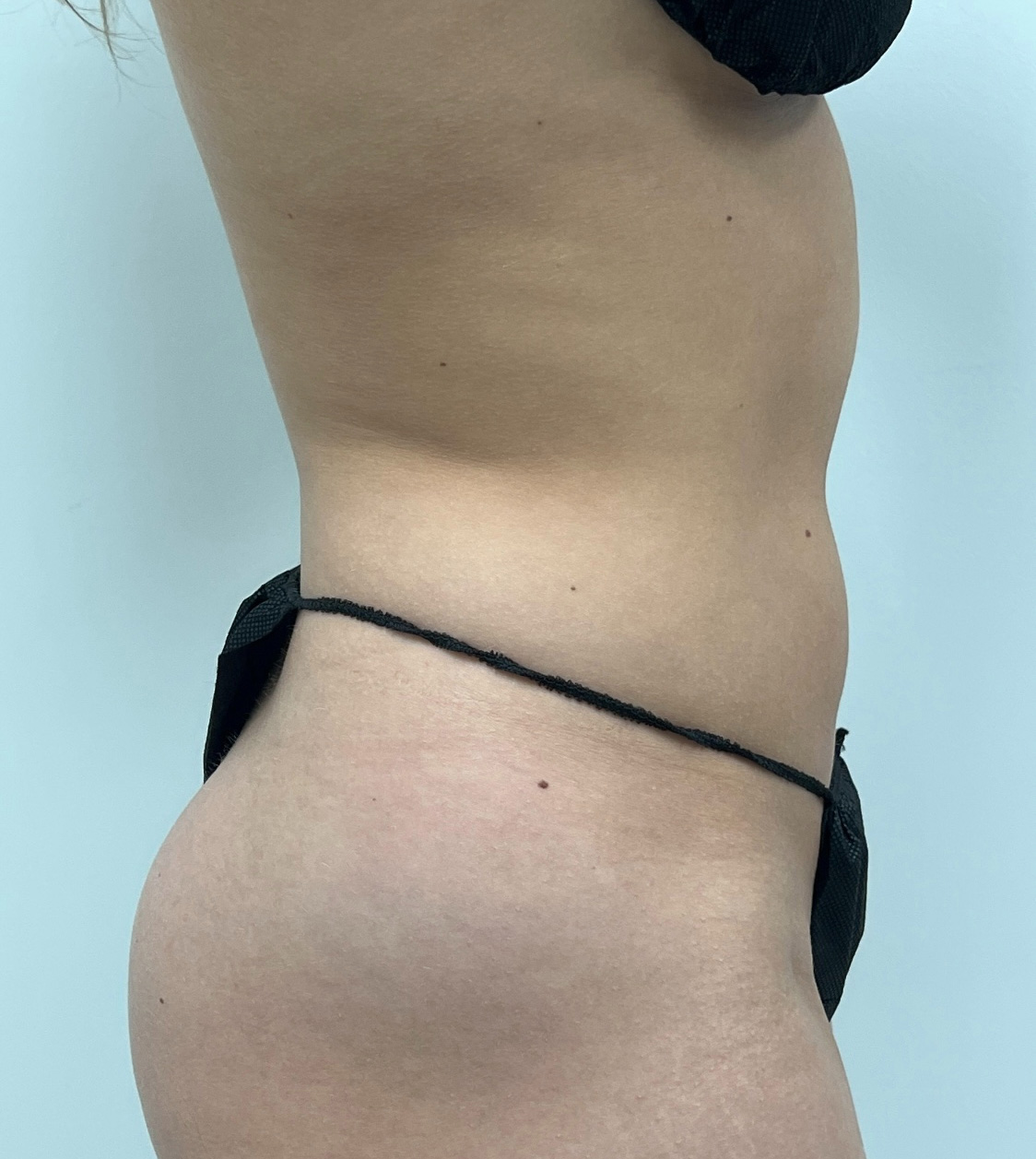 Liposuction