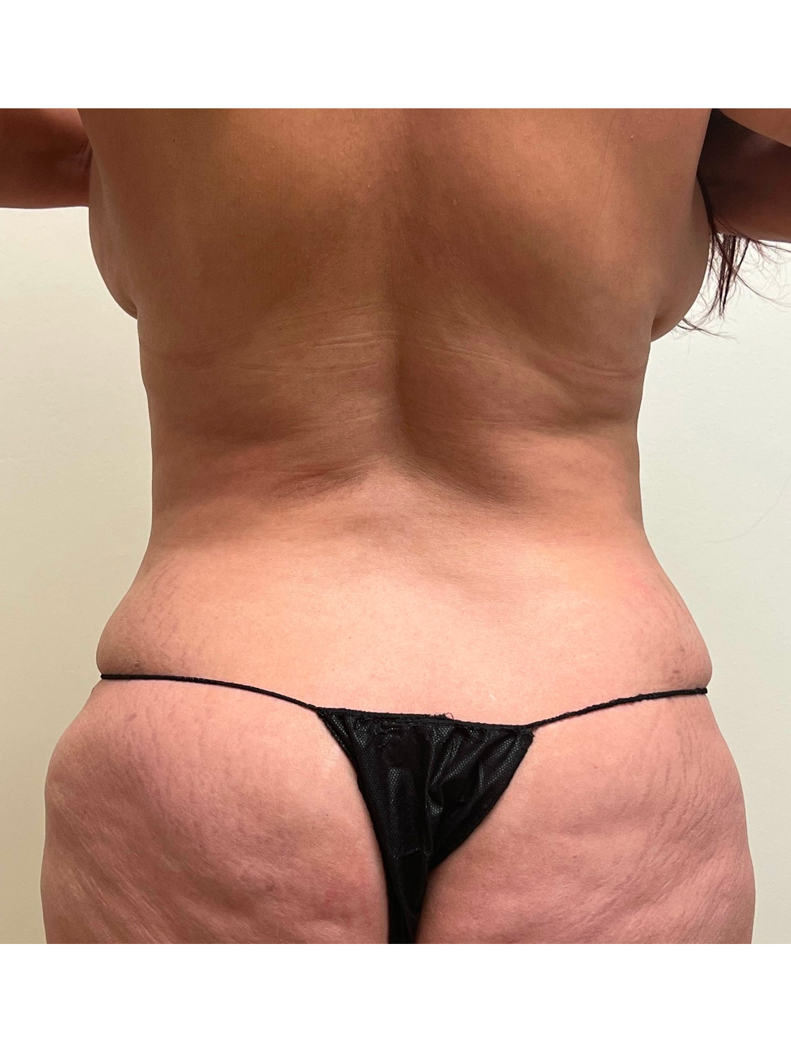 Tummy Tuck