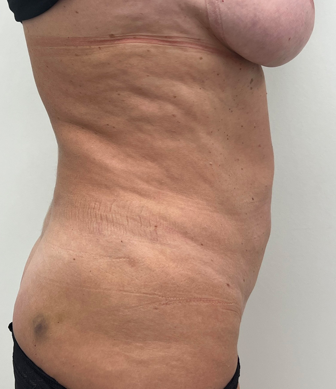 Tummy Tuck