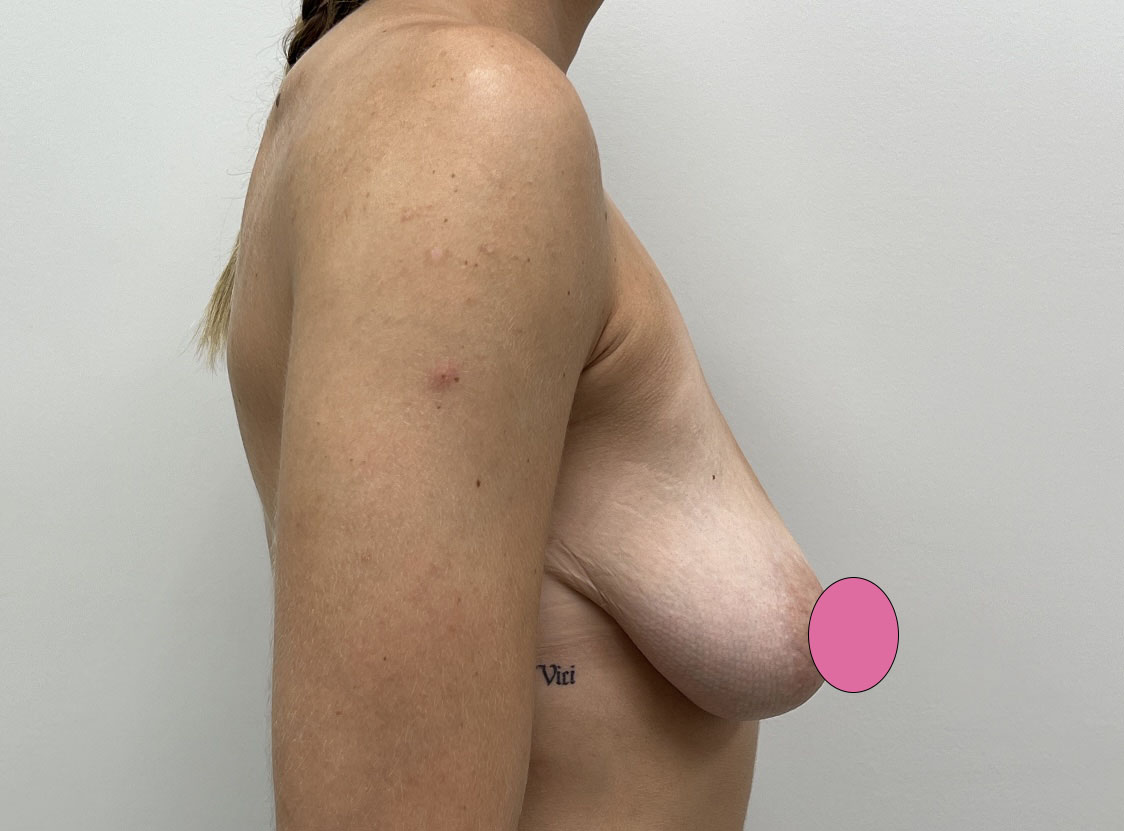 Breast Augmentation with Lift