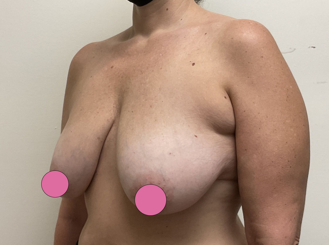 Breast Augmentation with Lift