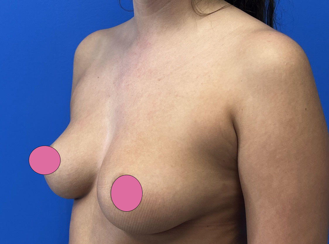 Breast Augmentation Before & After