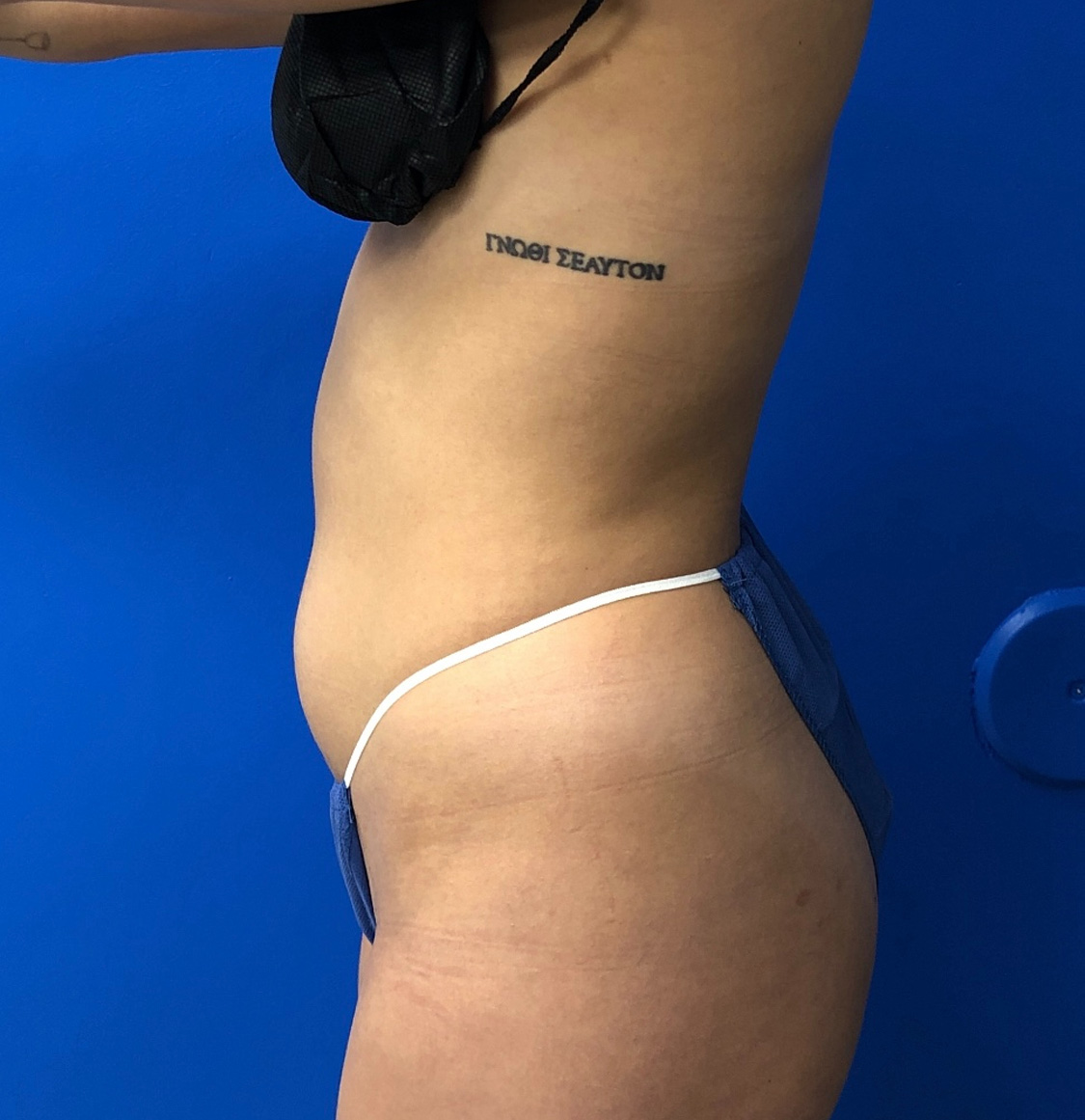 Brazilian Butt Lift Before & After