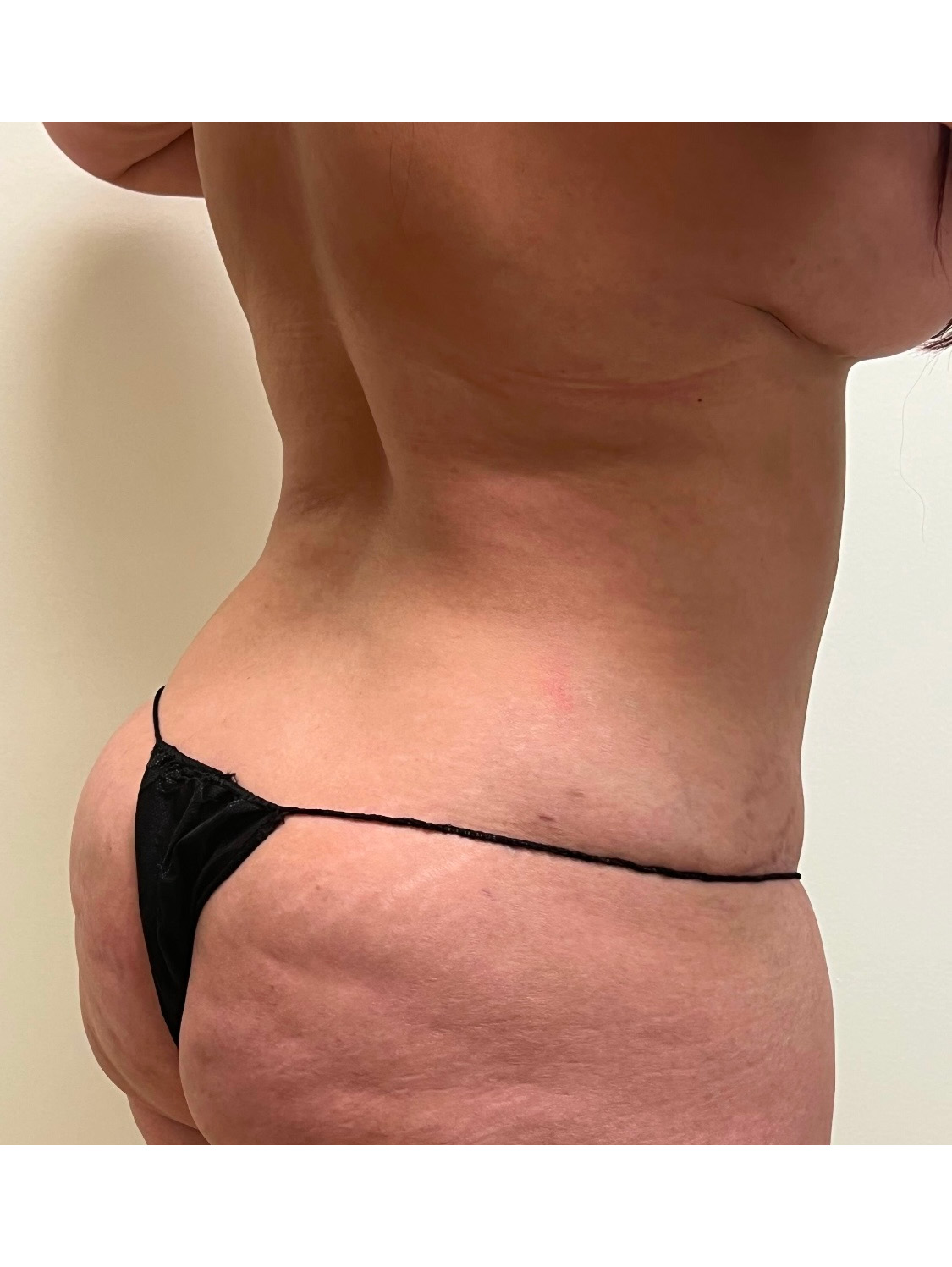 Tummy Tuck