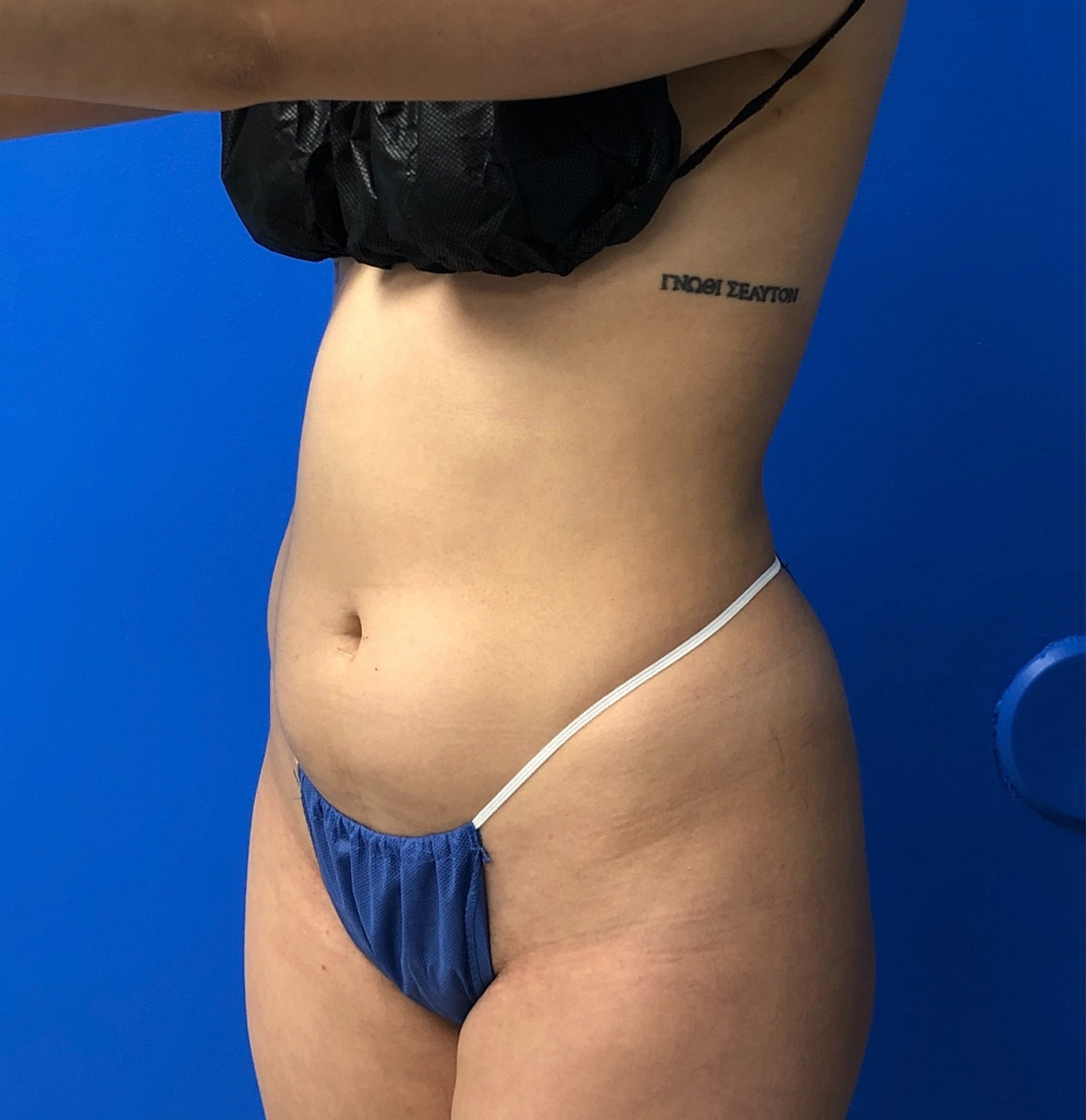 Brazilian Butt Lift Before & After