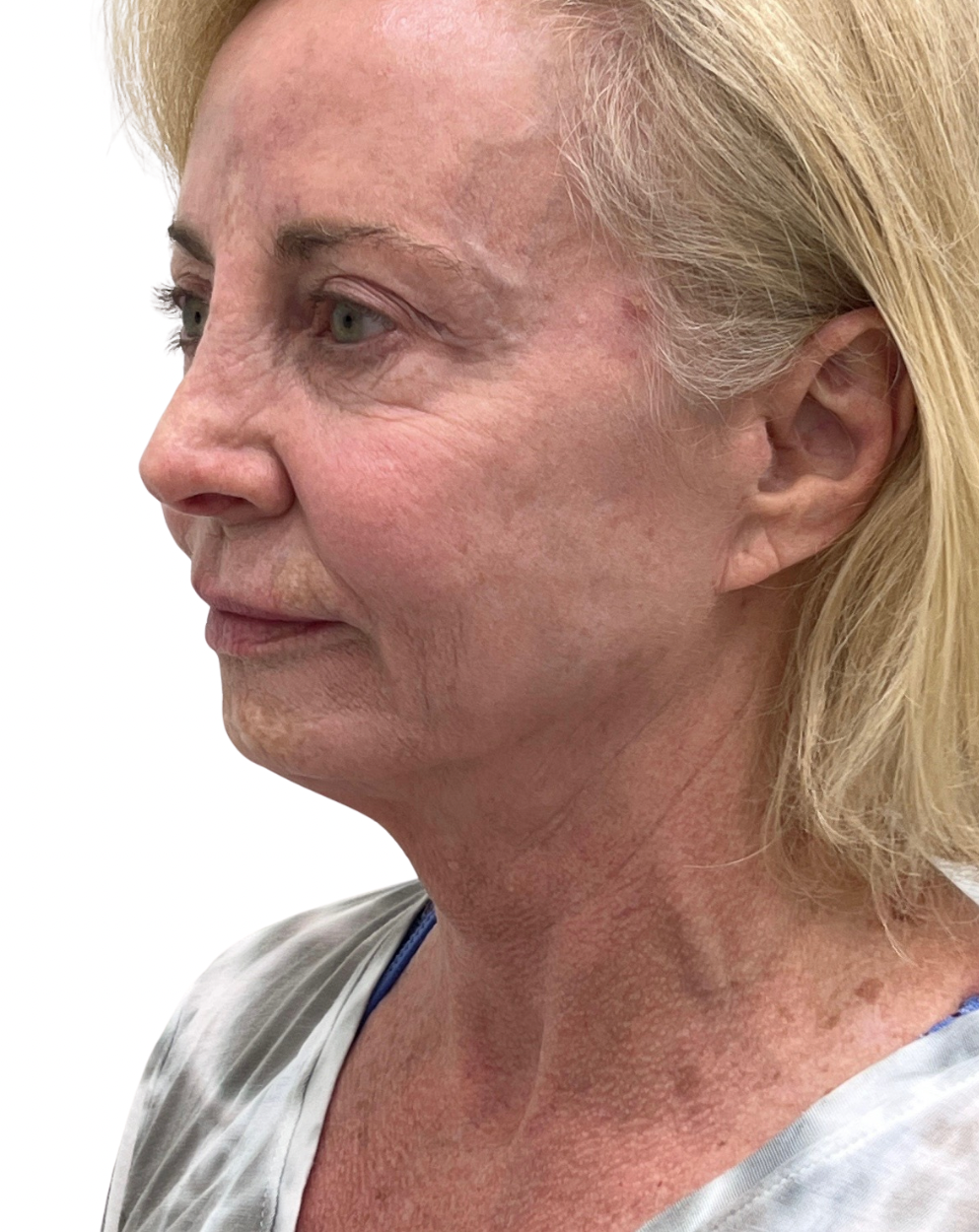 Facelift / Neck Lift