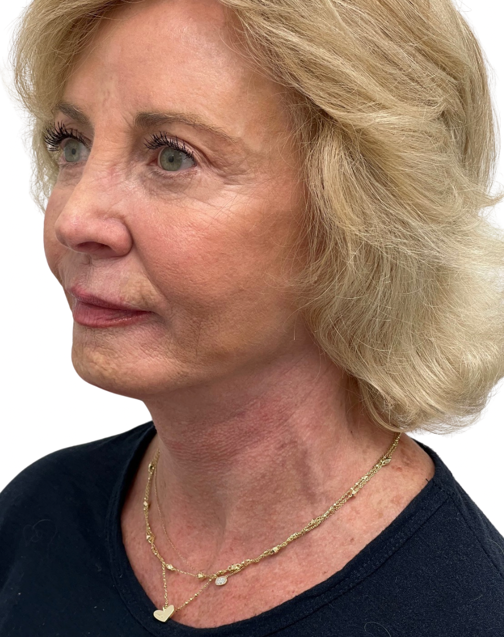 Facelift / Neck Lift