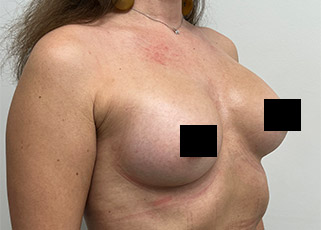 Breast Augmentation