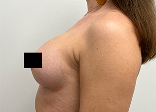 Breast Augmentation