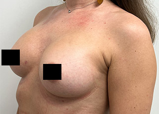 Breast Augmentation