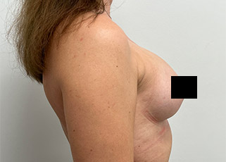 Breast Augmentation