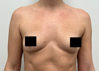 Breast Augmentation