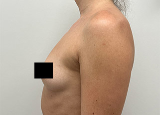 Breast Augmentation