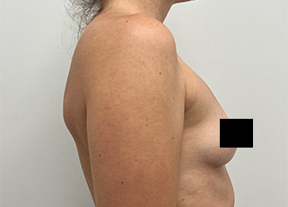 Breast Augmentation