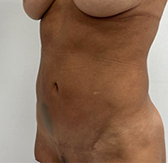 Mini Tummy Tuck Before and After