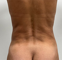 Mini Tummy Tuck Before and After