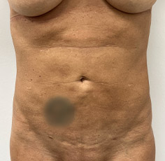 Le Spa Plastic Surgery Before and After Photos