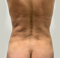Mini Tummy Tuck Before and After