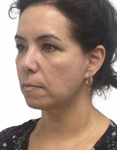 Le Spa Plastic Surgery Before and After Photos