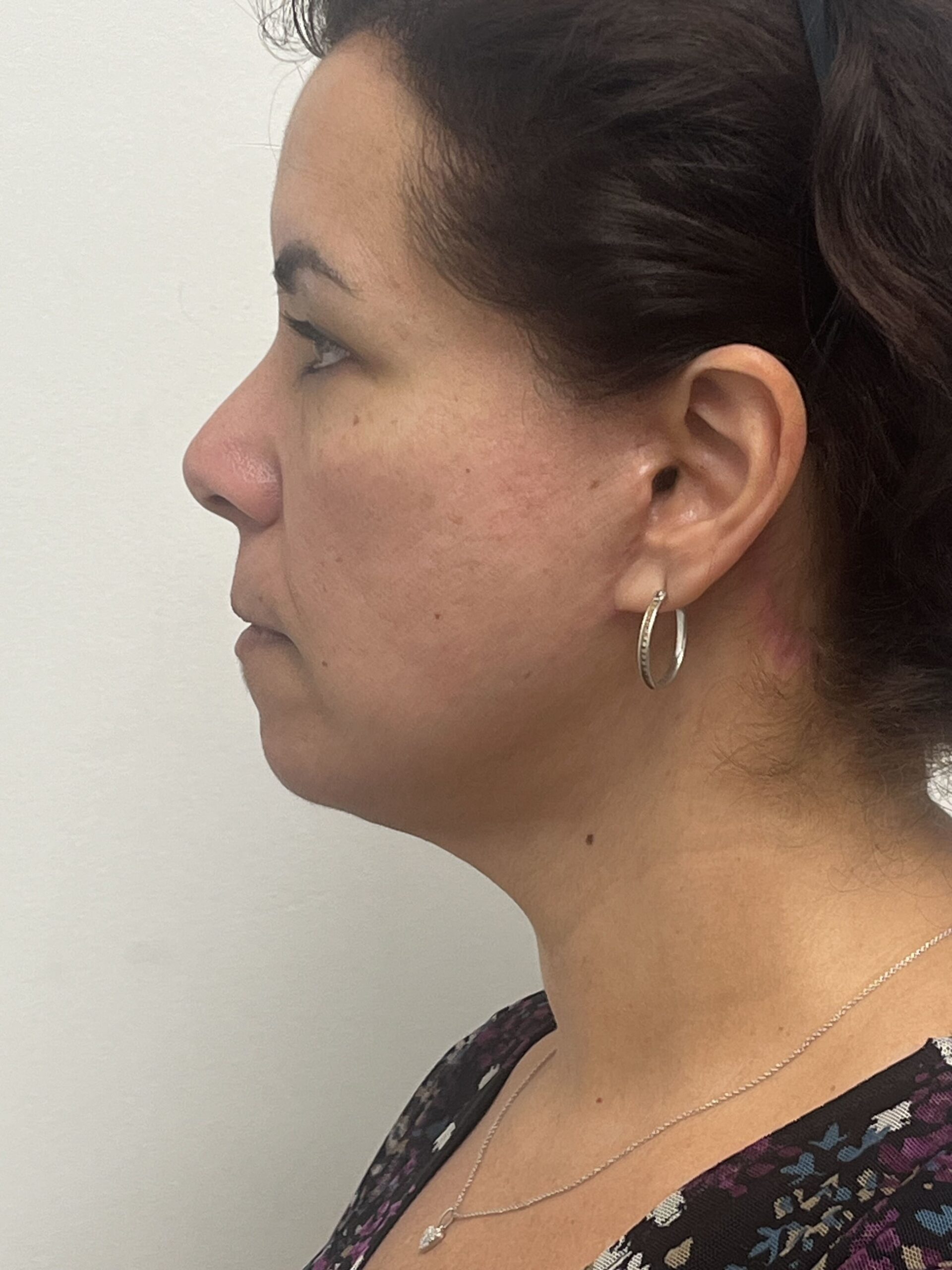 Facelift