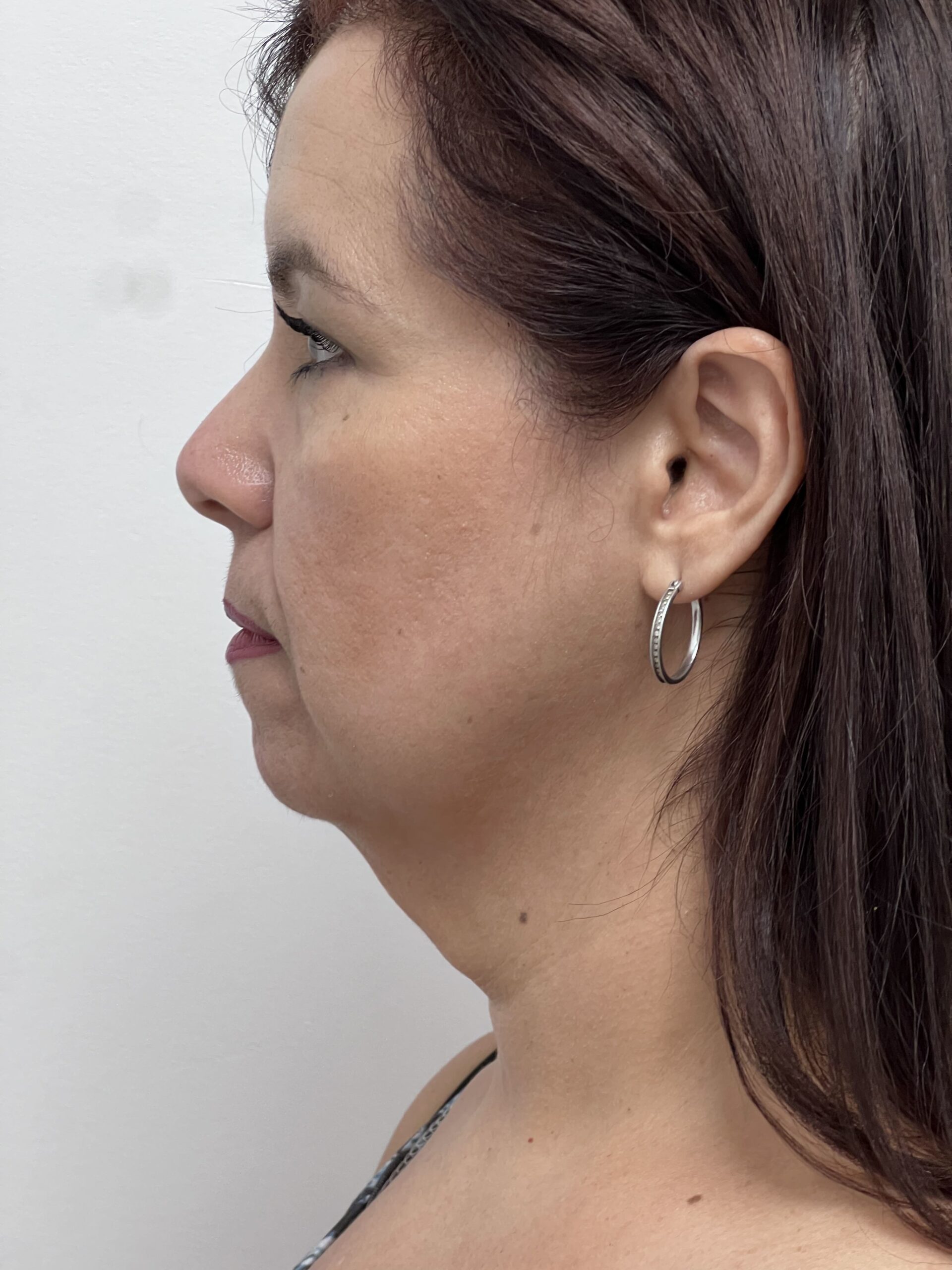 Facelift