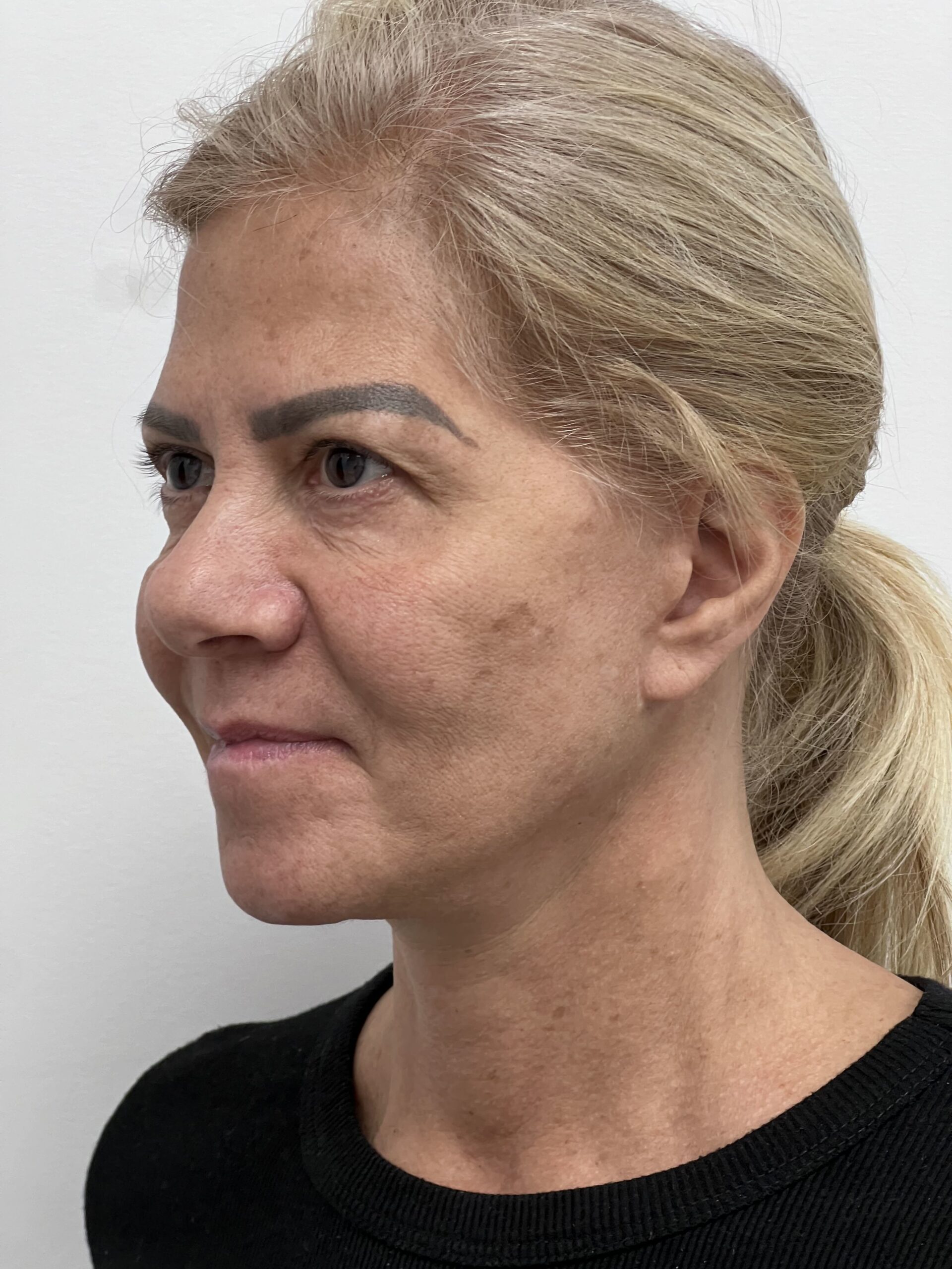 Facelift
