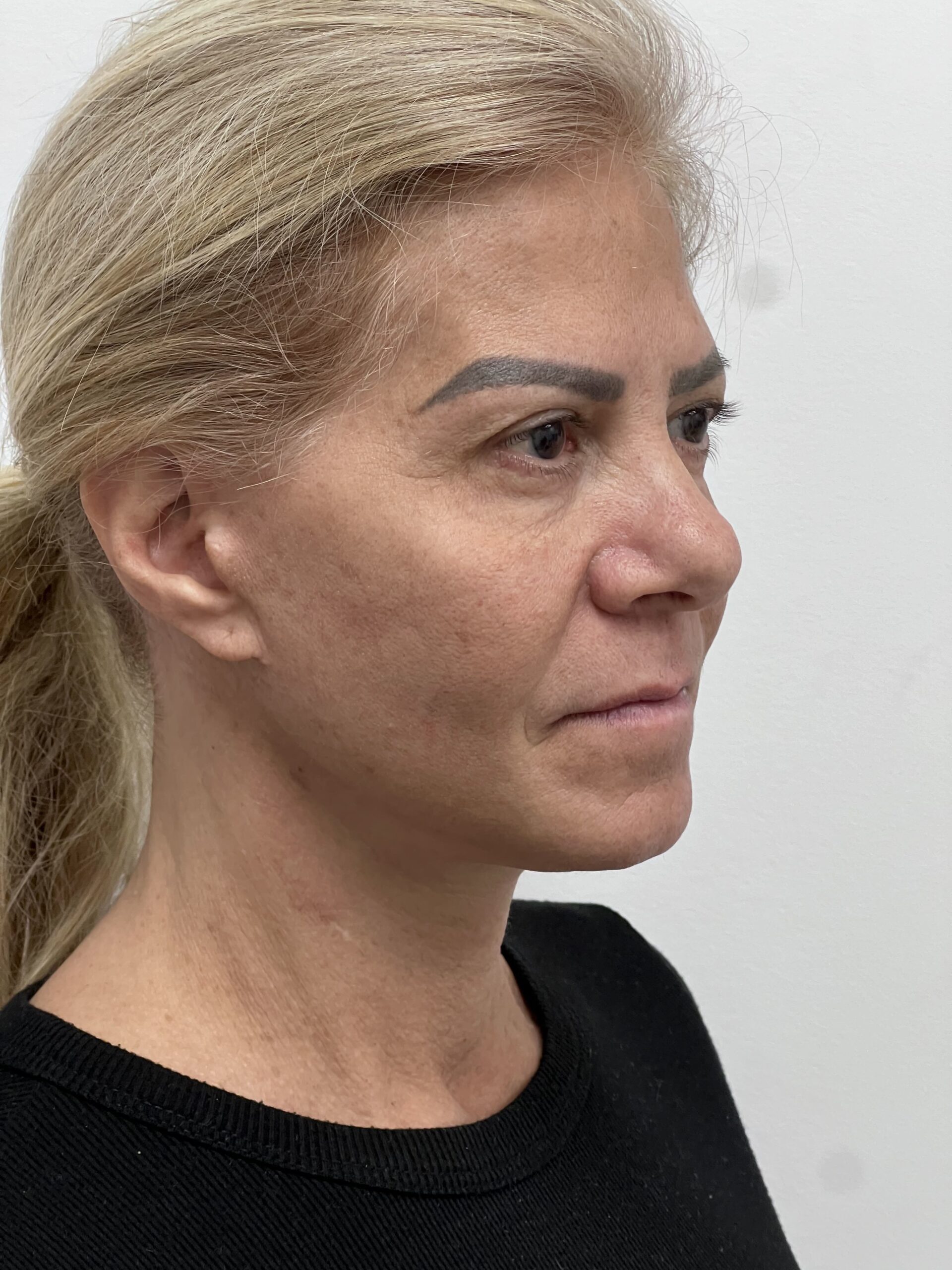 Facelift