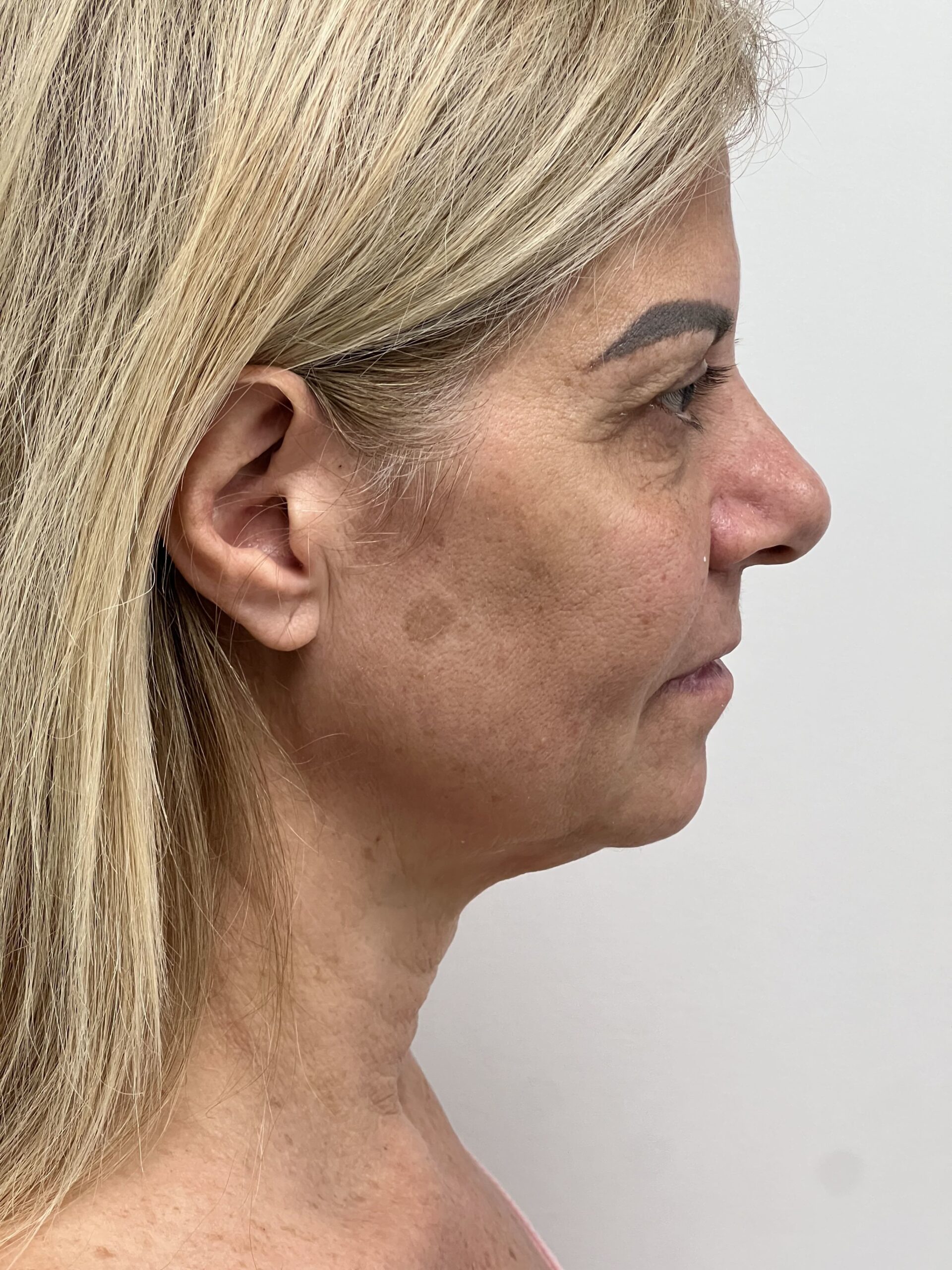 Facelift