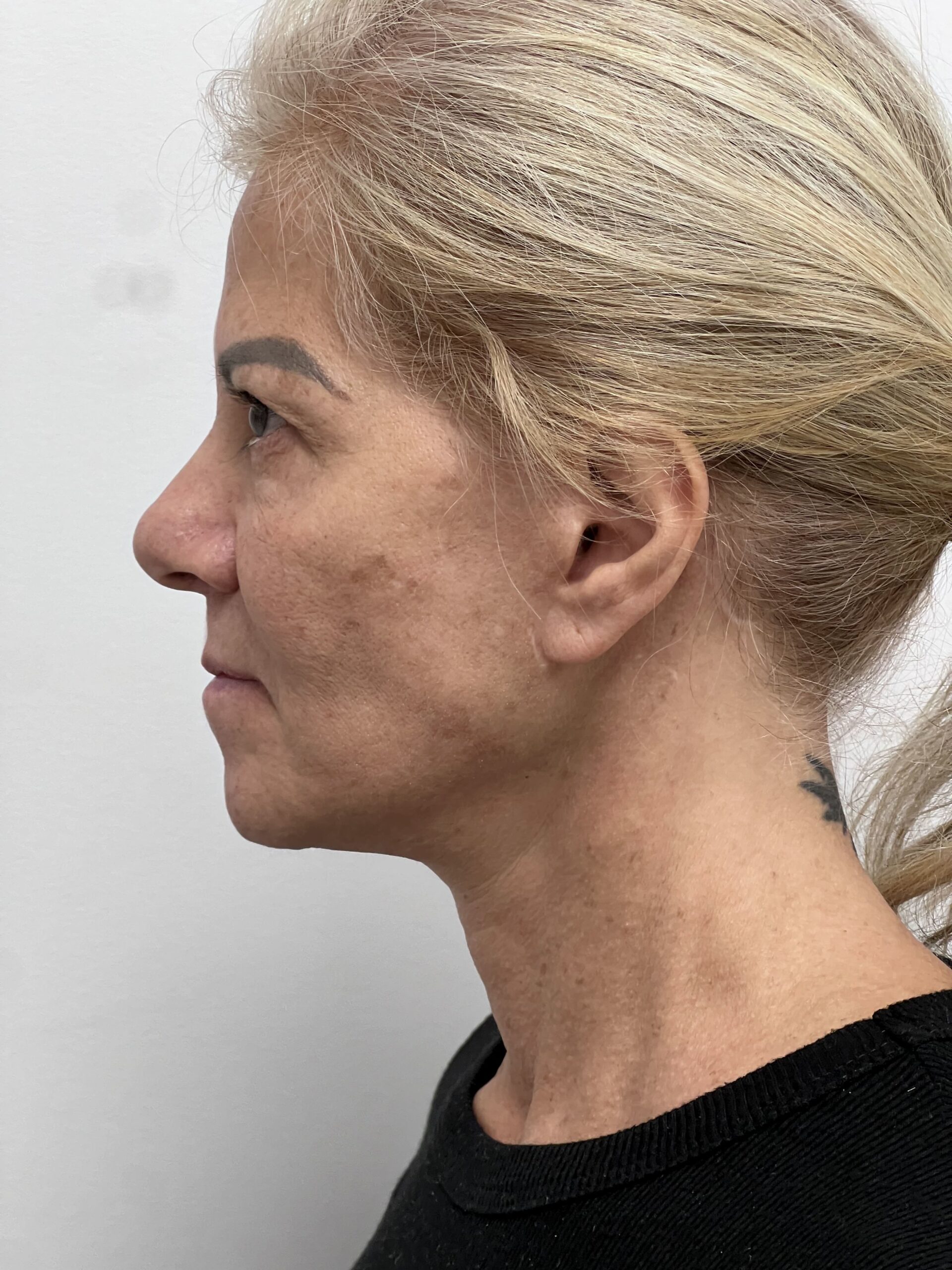 Facelift