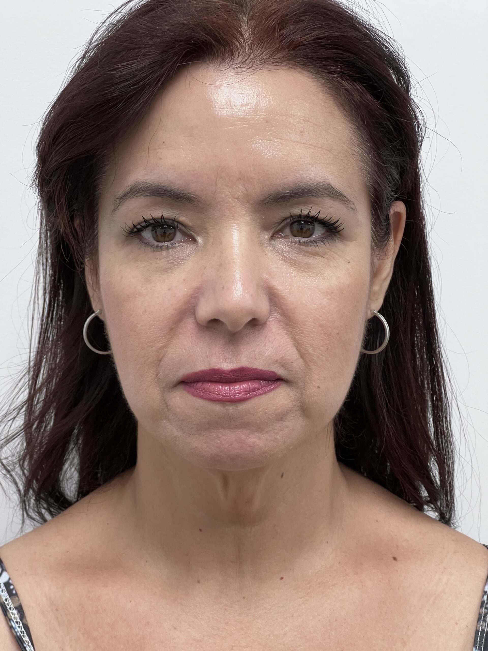 Facelift