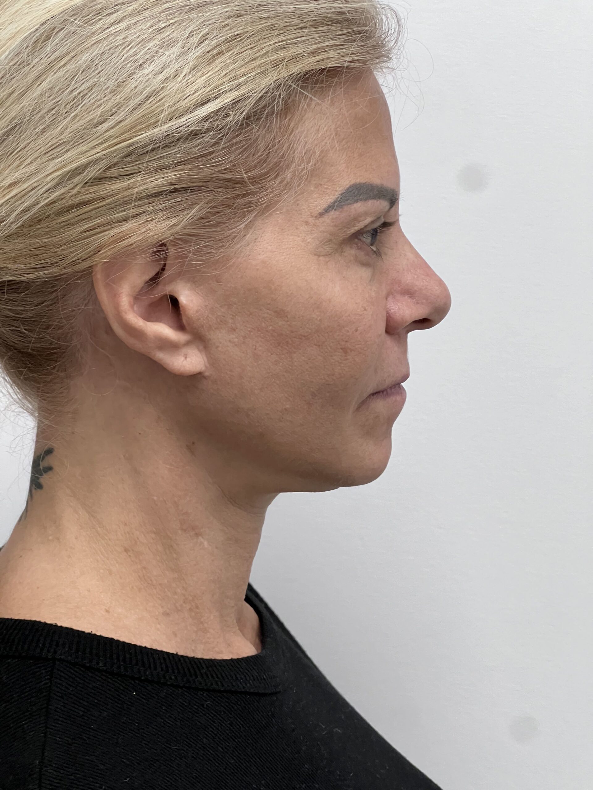 Facelift