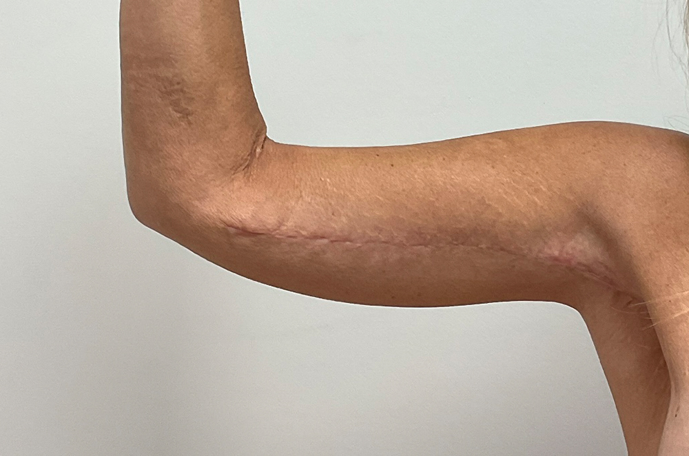 Arm Lift
