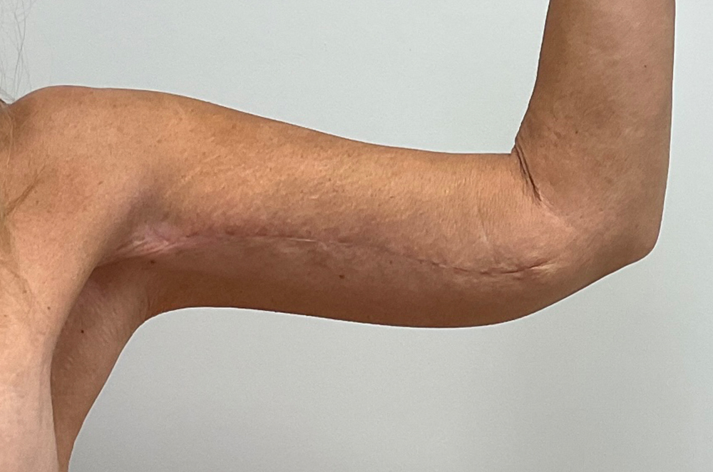 Arm Lift