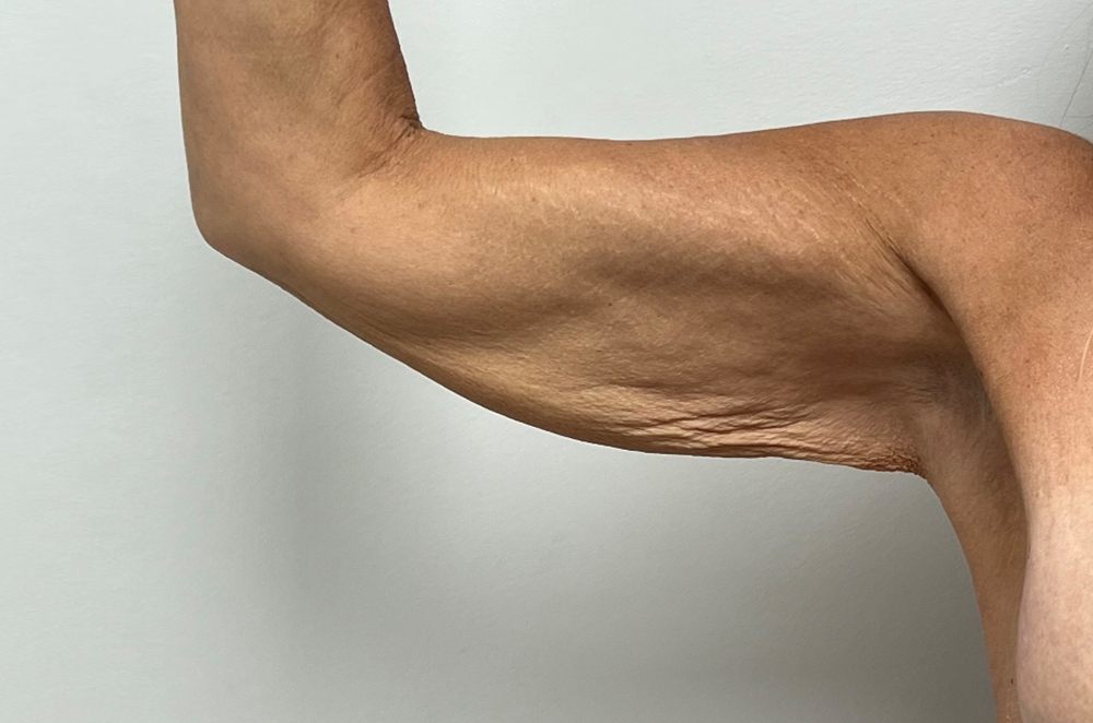 Arm Lift