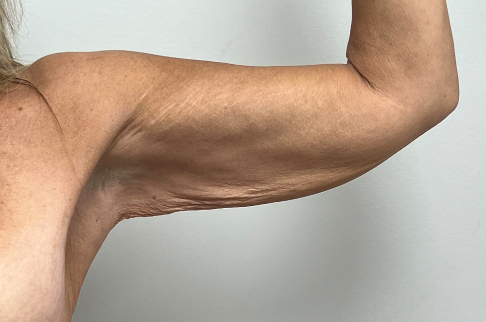Arm Lift