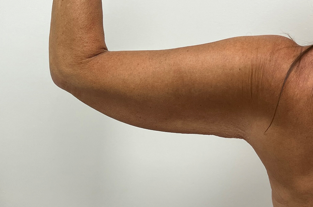 Arm Lift