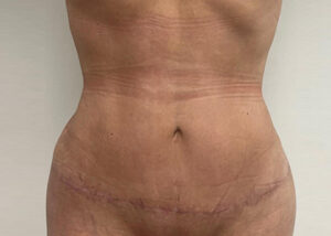 Le Spa Plastic Surgery Before and After Photos